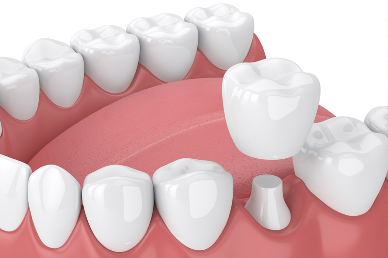 Dental Crowns in San Jose